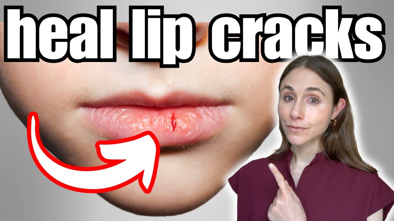 How To Heal Dry, Cracked Lips FAST