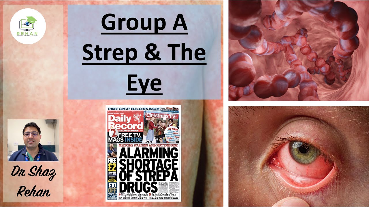 Group A Strep & How it Effects the Eye: Should I Be Worried? I Dr Shaz Rehan, 2023