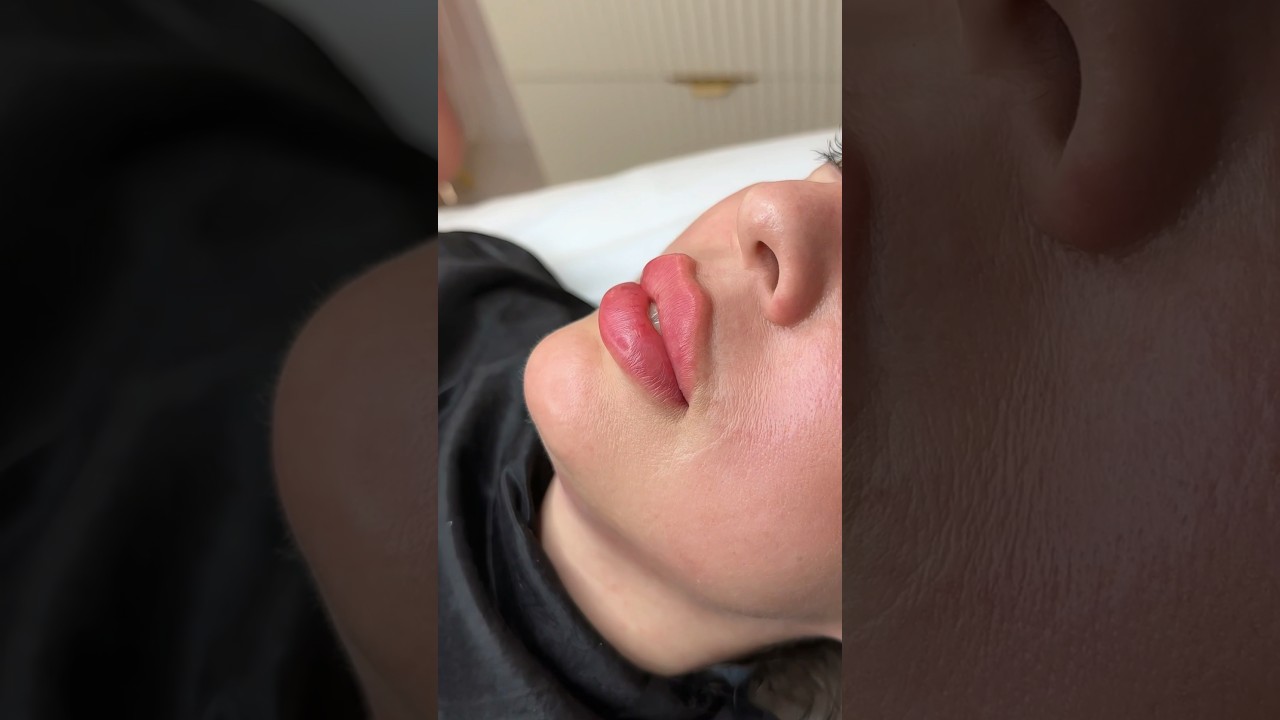 Lips beautification 💋 #lifting #fullface #lips #filler #jawline #lipfiller #contouring #beauty