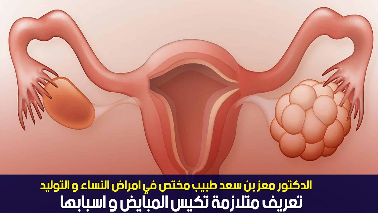 الدكتور معز بن سعد طبيب مختص في امراض النساء و التوليد:تعريف متلازمة تكيس المبايض و اسبابها