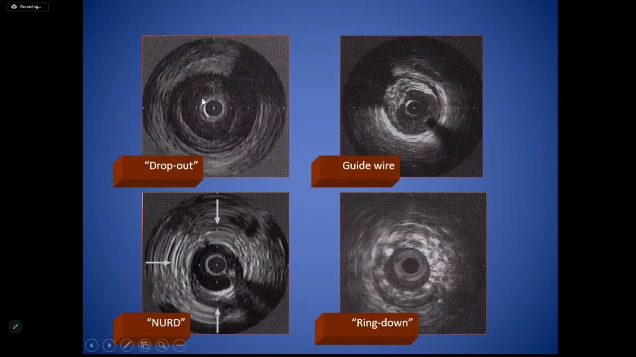 IVUS,OCT,FFR   Dr. Khaled Ali