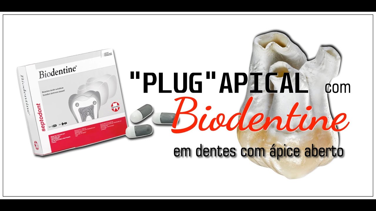 Plug Apical - Biodentine. mp4