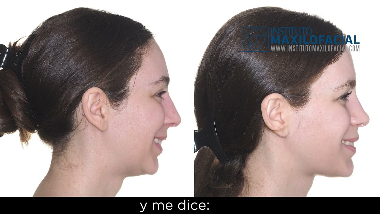 Cirugía bimaxilar Caso #107: Leanne- Retrusión maxilo-mandibular, falta de soporte del tejido blando