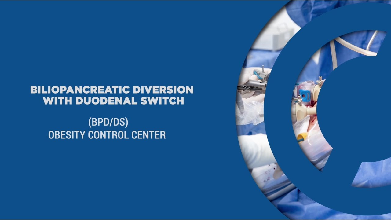 Biliopancreatic Diversion with Duodenal Switch (BPD/DS) Explained by Dr. Ariel Ortiz
