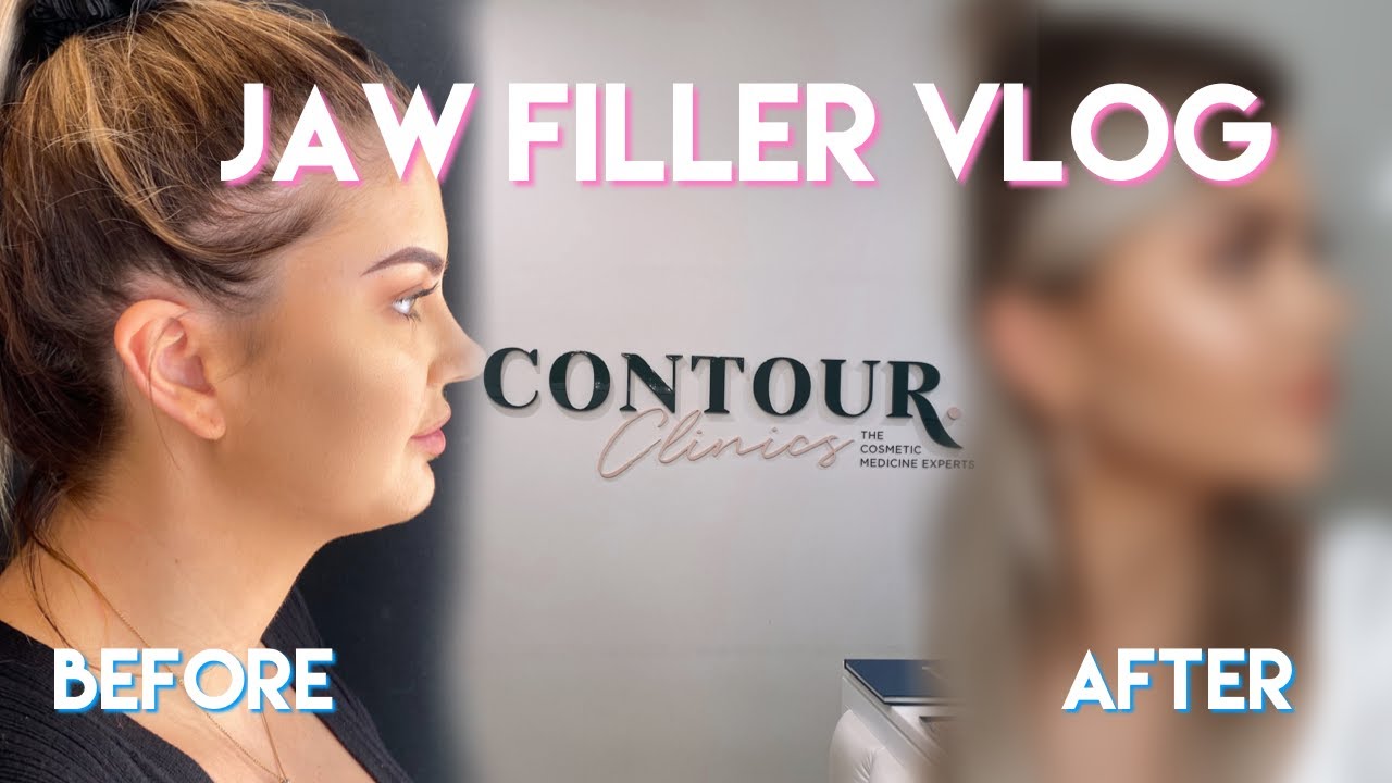 I GOT JAW FILLER FOR THE FIRST TIME