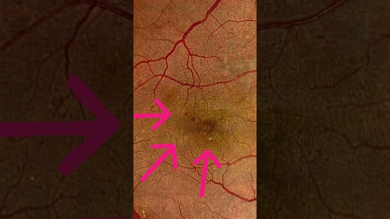 Let&rsquo;s dive into some non proliferative diabetic retinopathy.. #retina #oftalmo #ophthalmology #of