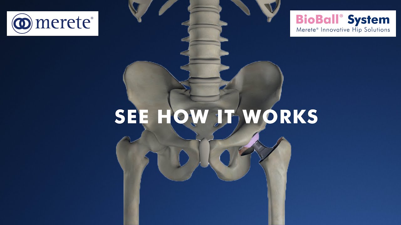 Animation: BioBall&reg; AdapterSelector - See How it Works (Hip Surgery) Englisch