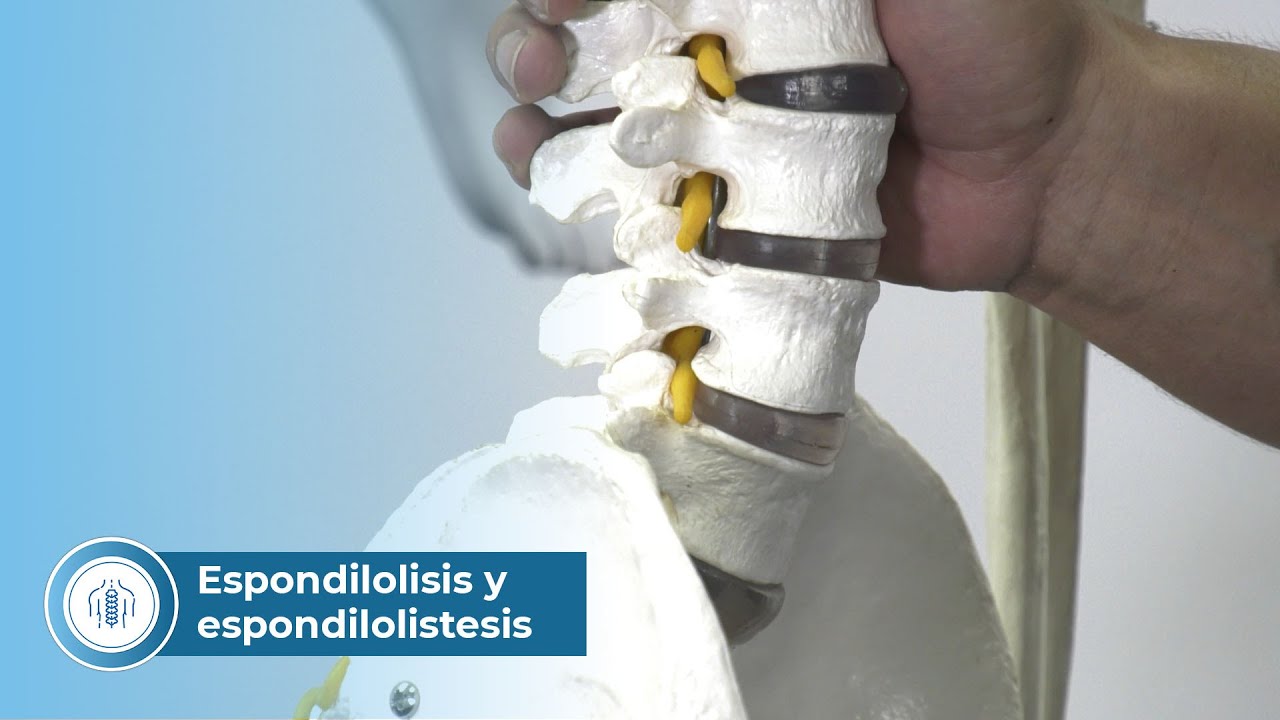 Espondilolisis y espondilolistesis