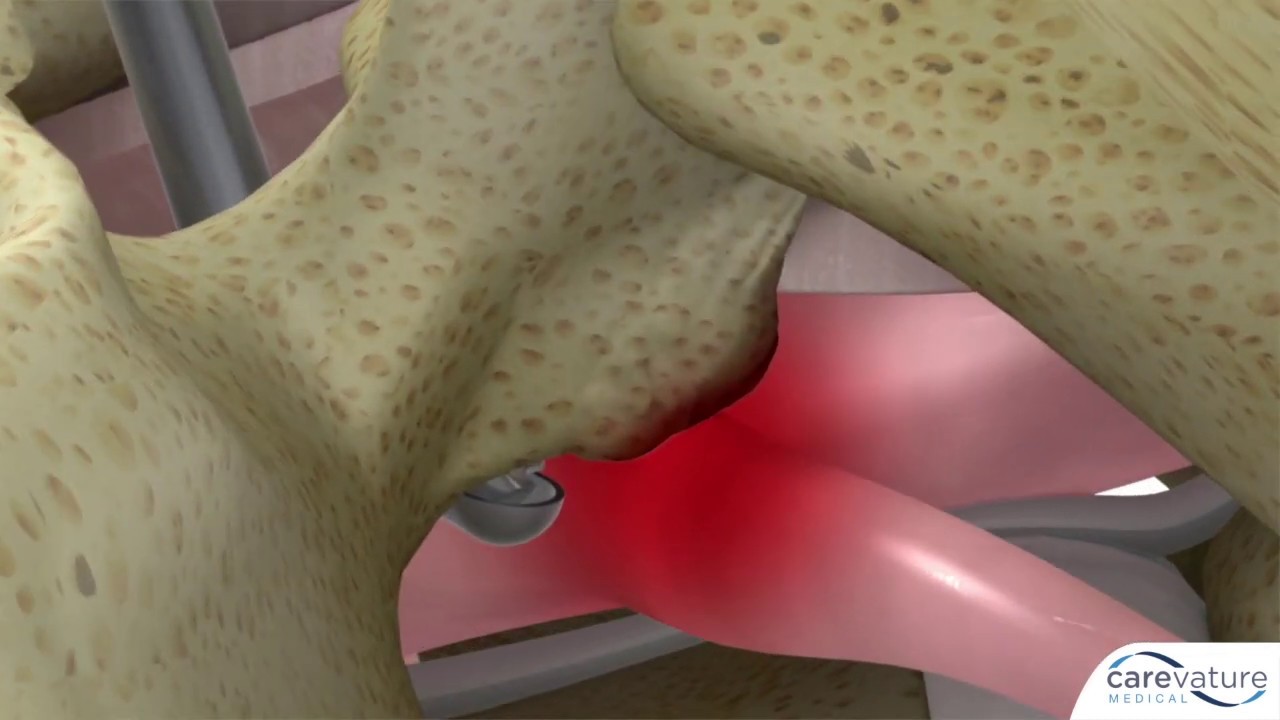 Larry Khoo, MD - Dreal&reg; technology for lumbar foraminotomy