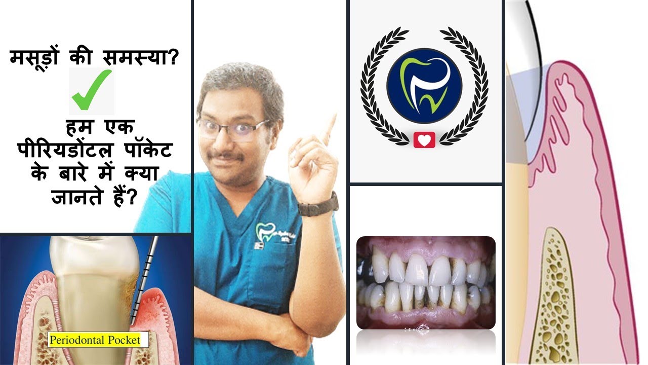 Dr Rudra Mohan |एक पेरियोडॉन्टल पॉकेट क्या है? अगर आपको मसूड़े की समस्या है, तो इस एपिसोड को देखें!