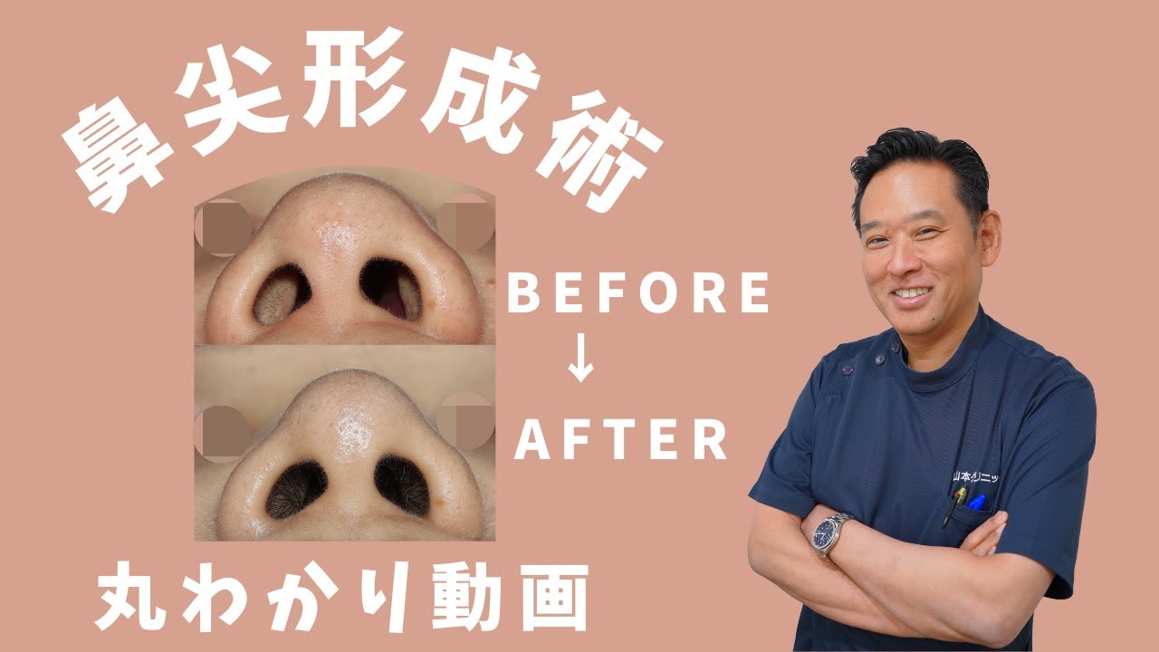 【鼻尖形成術だけ症例】@山本クリニック　#鼻尖形成だけ　#鼻整形　#鼻整形ダウンタイム　#鼻先整形
