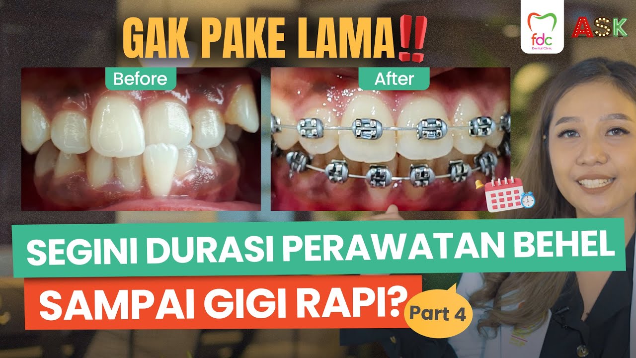 YAKIN UDAH TAU❓l Berapa Lama Perawatan Gigi Dengan Behel❓🤔 | ASK DENTIST
