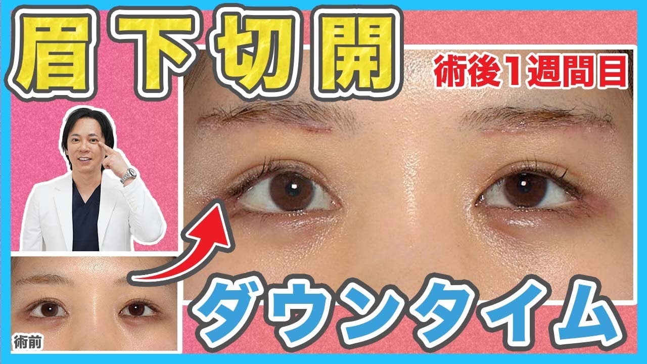 【眉下切開】傷跡はいつまで目立つ？眉下切開のダウンタイムについて
