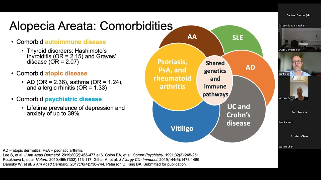 Alopecia areata - Brett King, MD, PhD