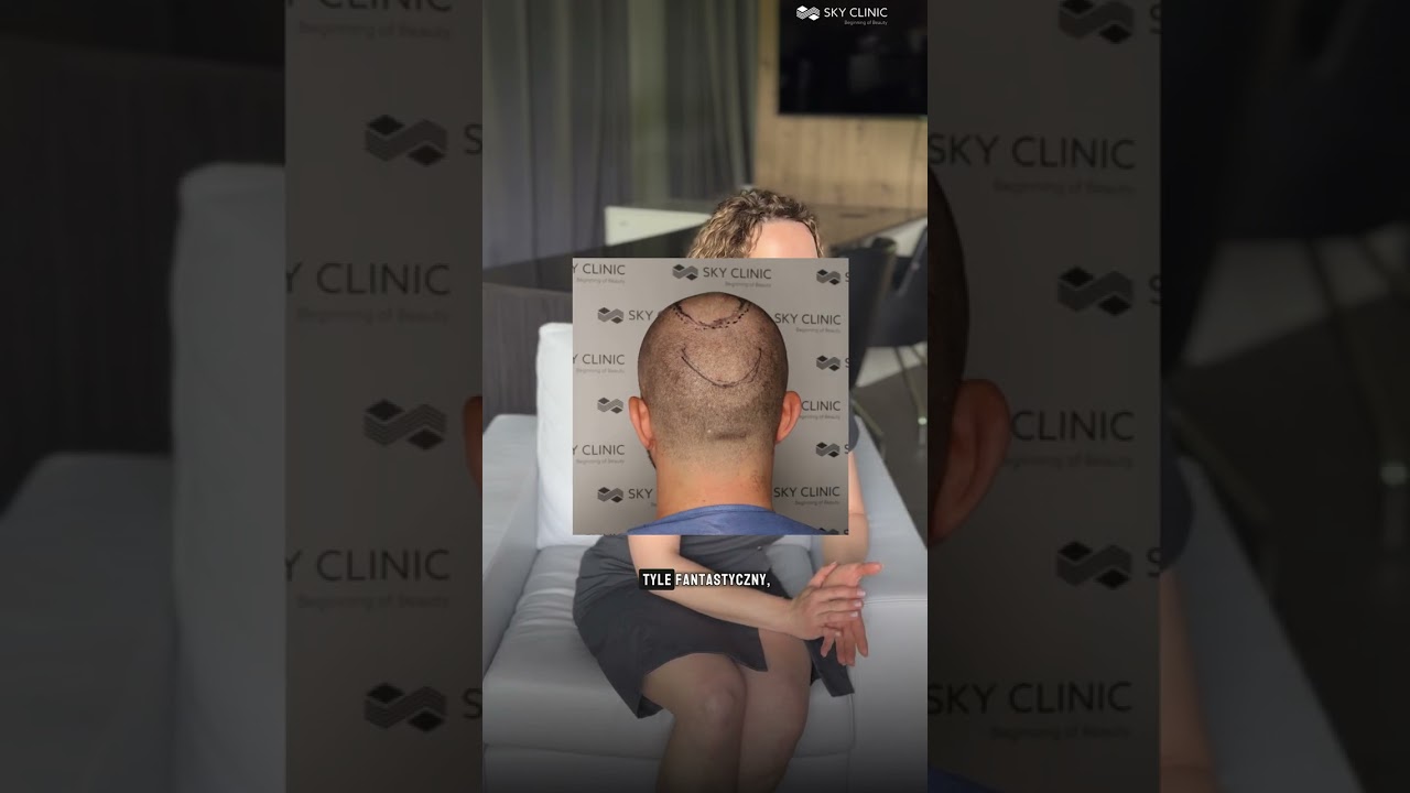 Na czym polega przeszczep włosów? Dr Janiak tłumaczy! 