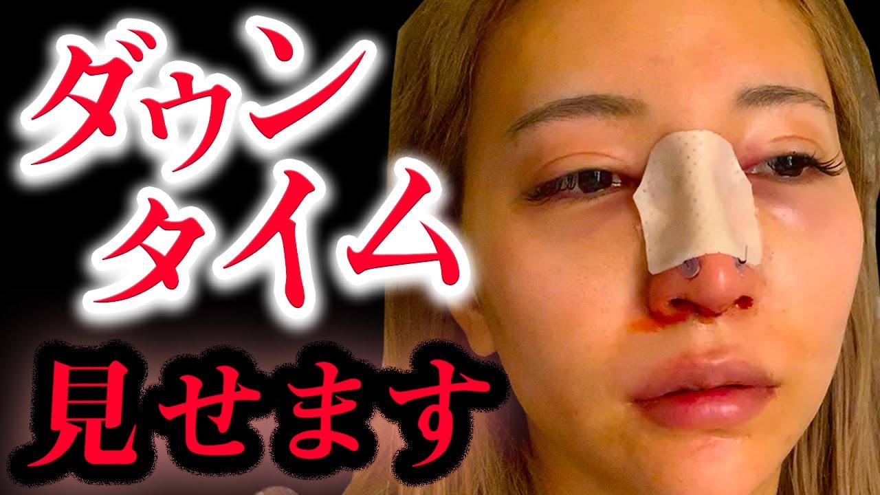 【美容整形】ダウンタイムの経過、全てお見せします。