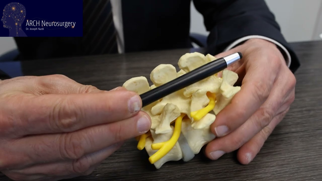Lumbar Laminectomy