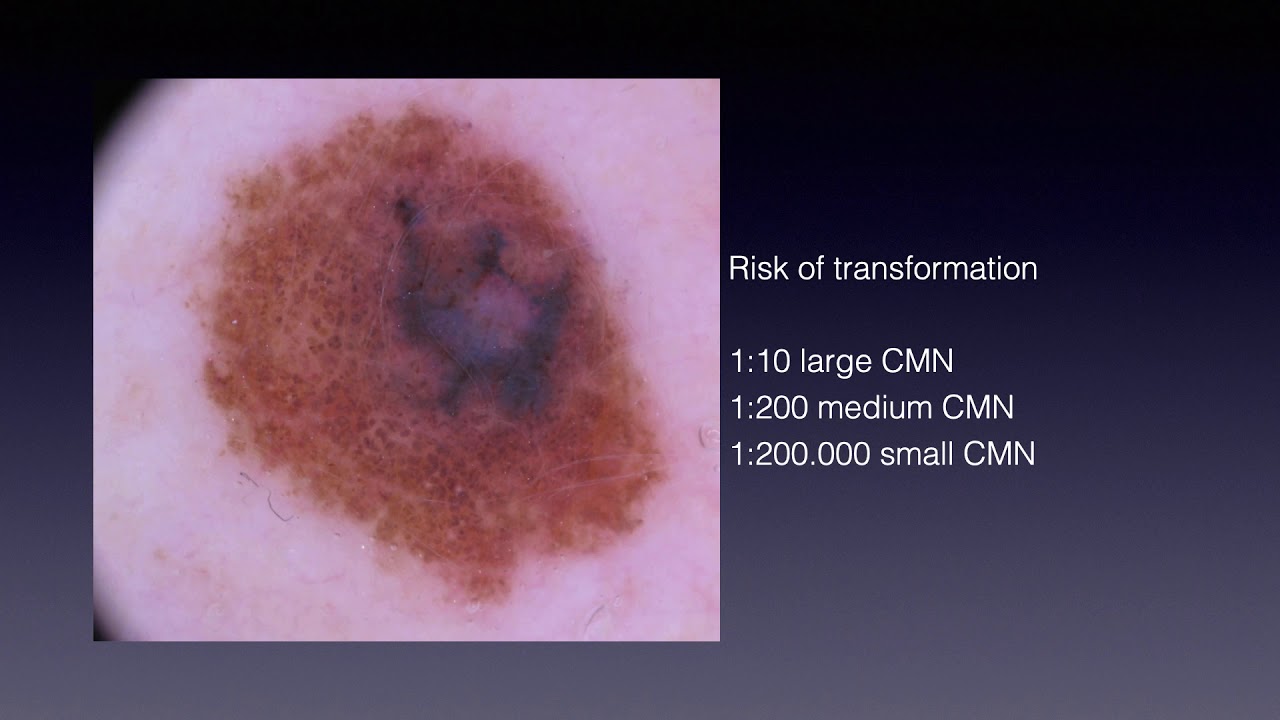 Melanoma in congenital nevi - Dr. Giuseppe Argenziano