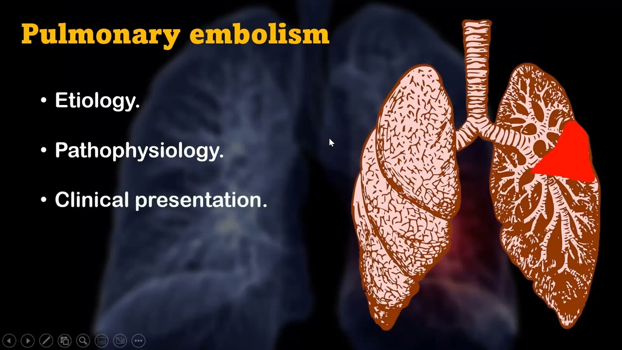 Pulmonary embolism: diagnostic workup and management guidelines