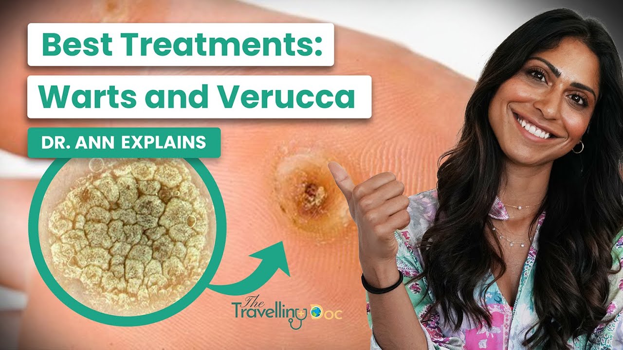 Wart & Verruca Removal: What Works (Doctor Explains)