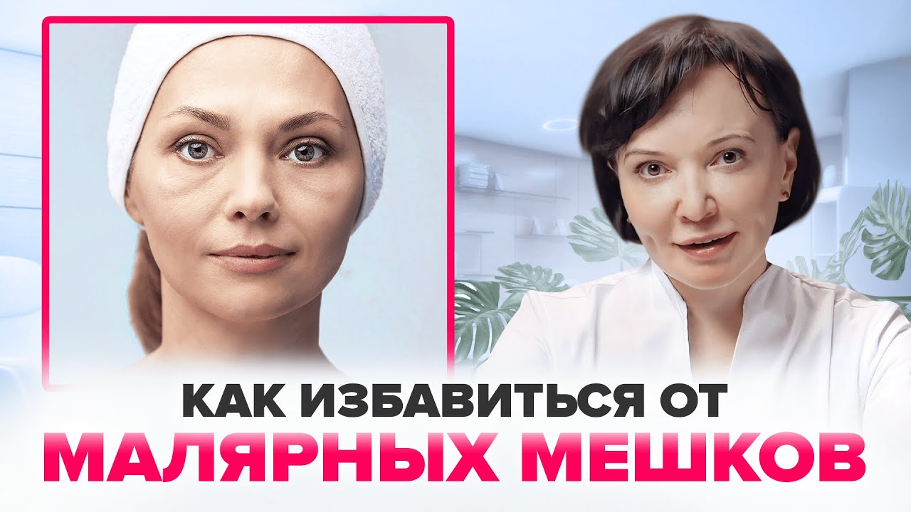 МАЛЯРНЫЕ МЕШКИ. Как избавиться от малярных мешков под глазами без операции | Ирина Рахова