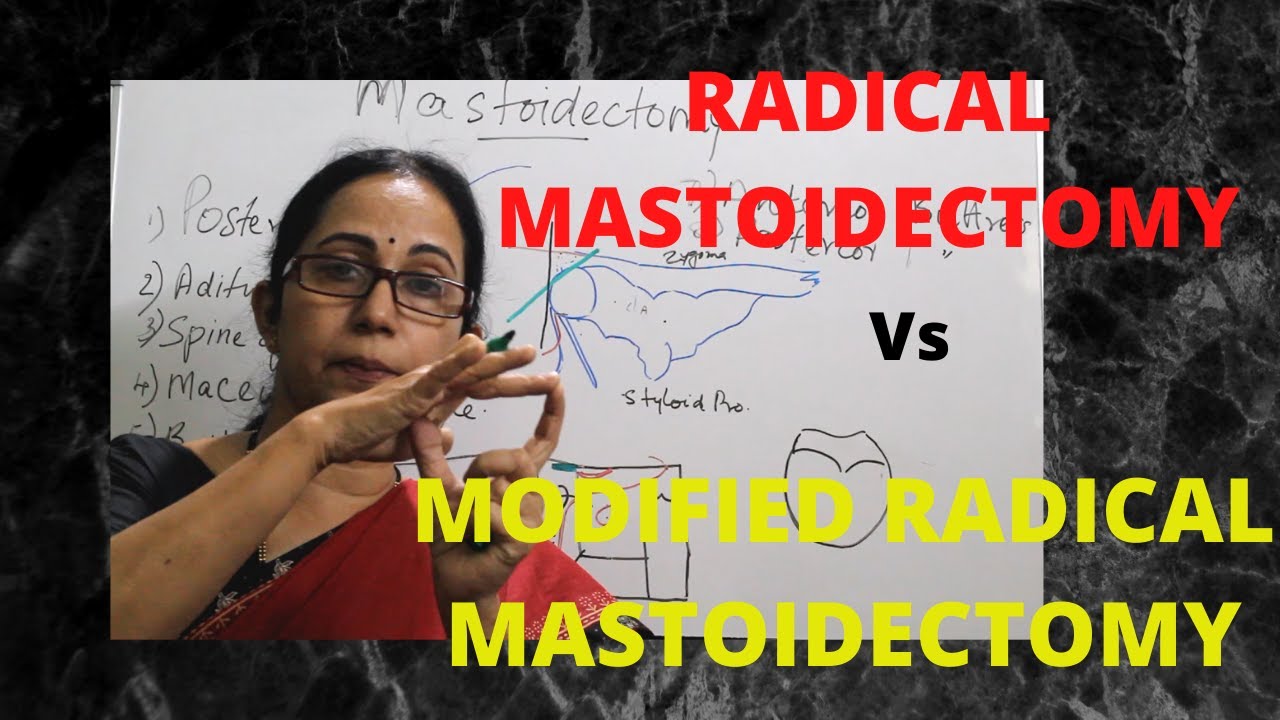 070.Radical Mastoidectomy Vs Modified Radical Mastoidectomy  #mastoidoperations #surgeryeducation