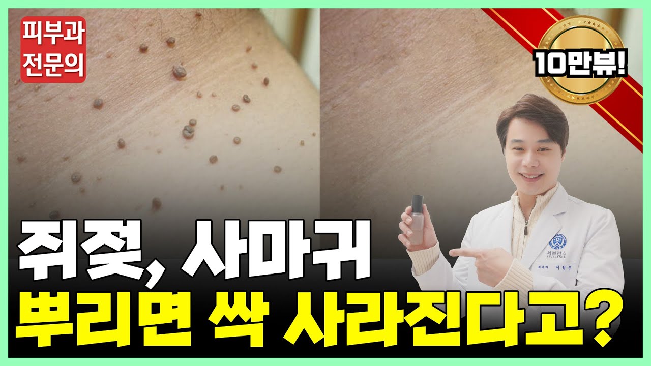 이것만 뿌리면 쥐젖, 사마귀 전부 쉽게 제거? 피부과전문의가 알려주는 쥐젖, 편평사마귀 없애는 법 | 부산피부과