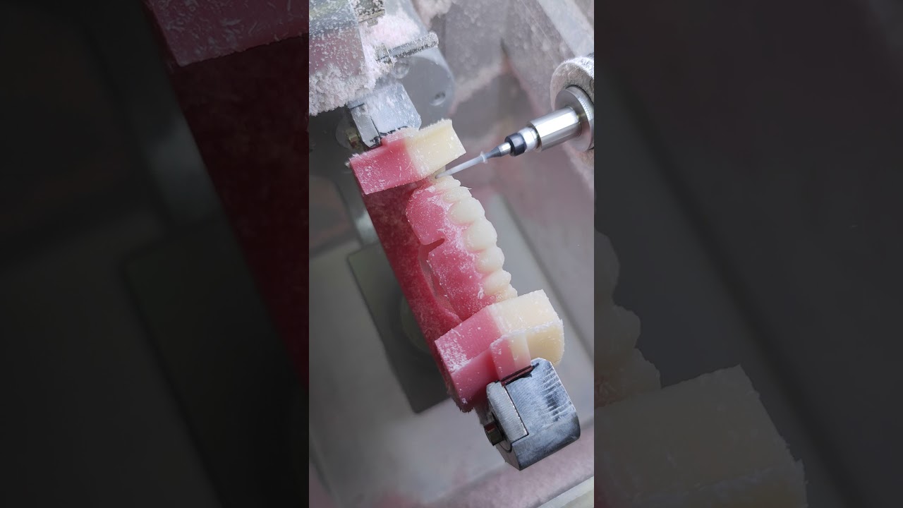 15-Yr Expertise: Full-Mouth Denture CNC Milling#dentaltech #cadcam #dentalartistry #dentist #dental