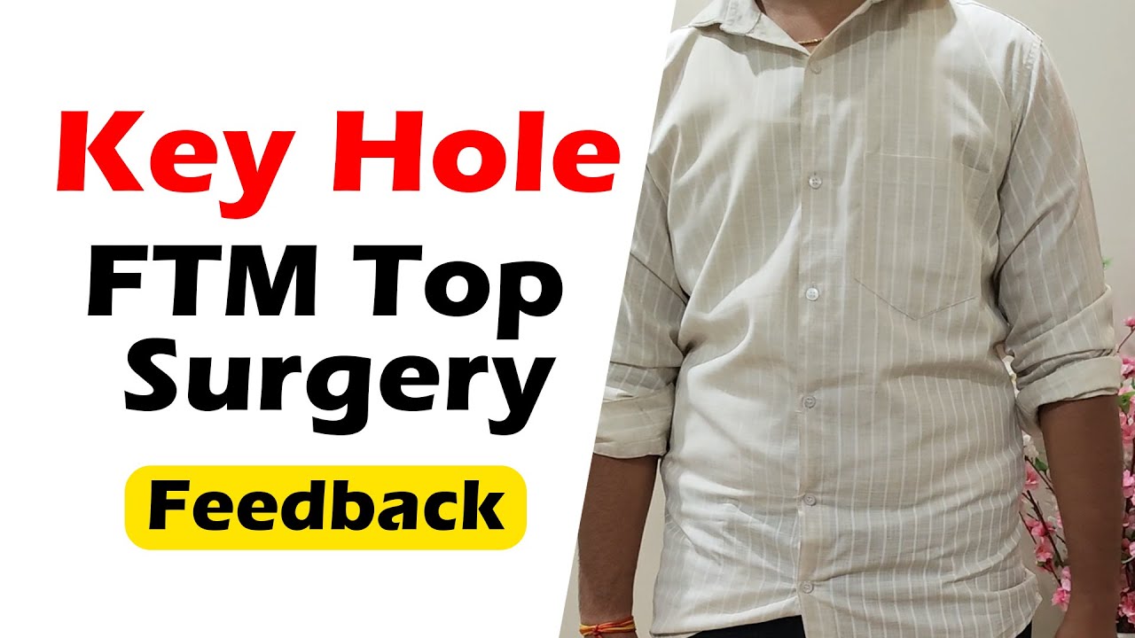 Keyhole FTM Top surgery result after one year