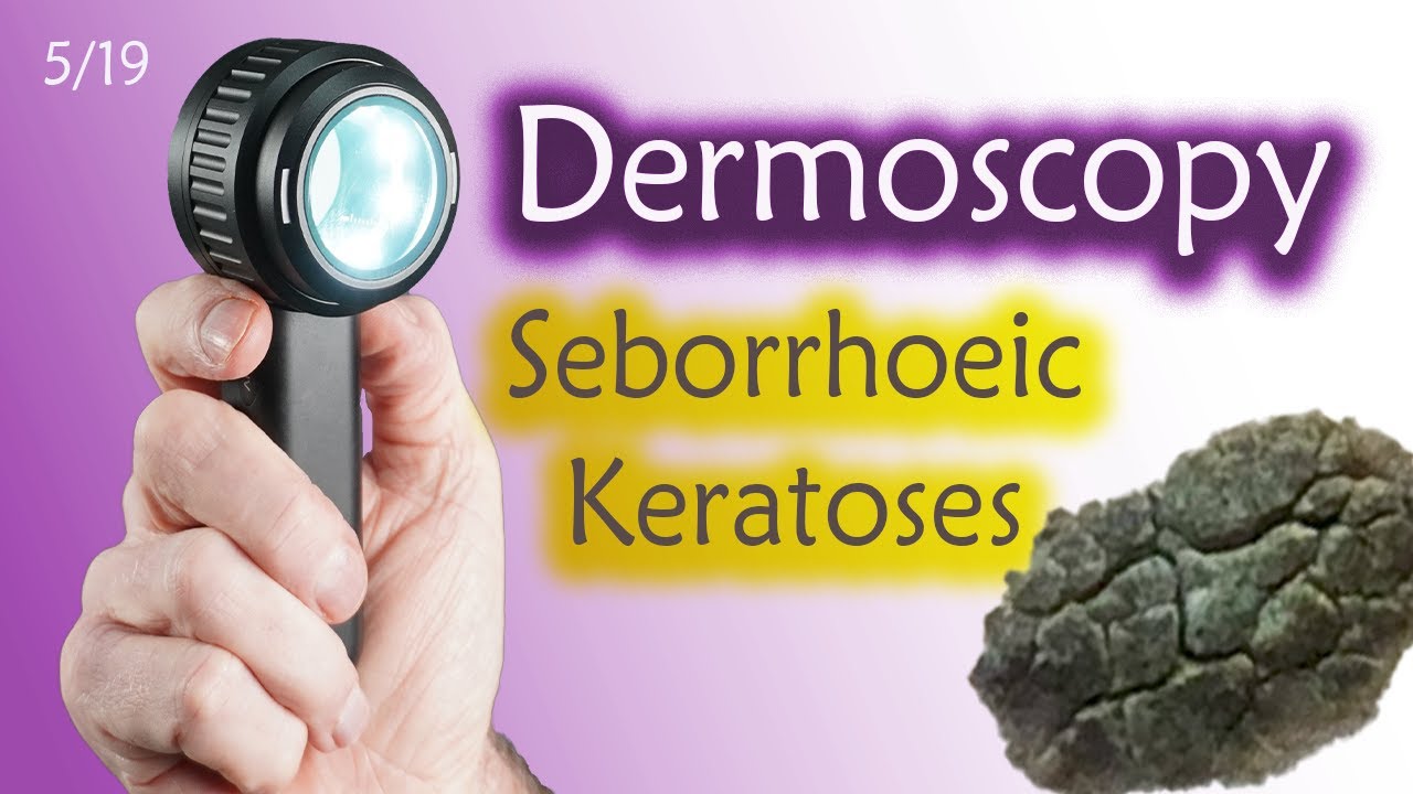 Are Seborrhoeic Keratoses [Seb K] the Chameleon of Primary Care Dermoscopy?