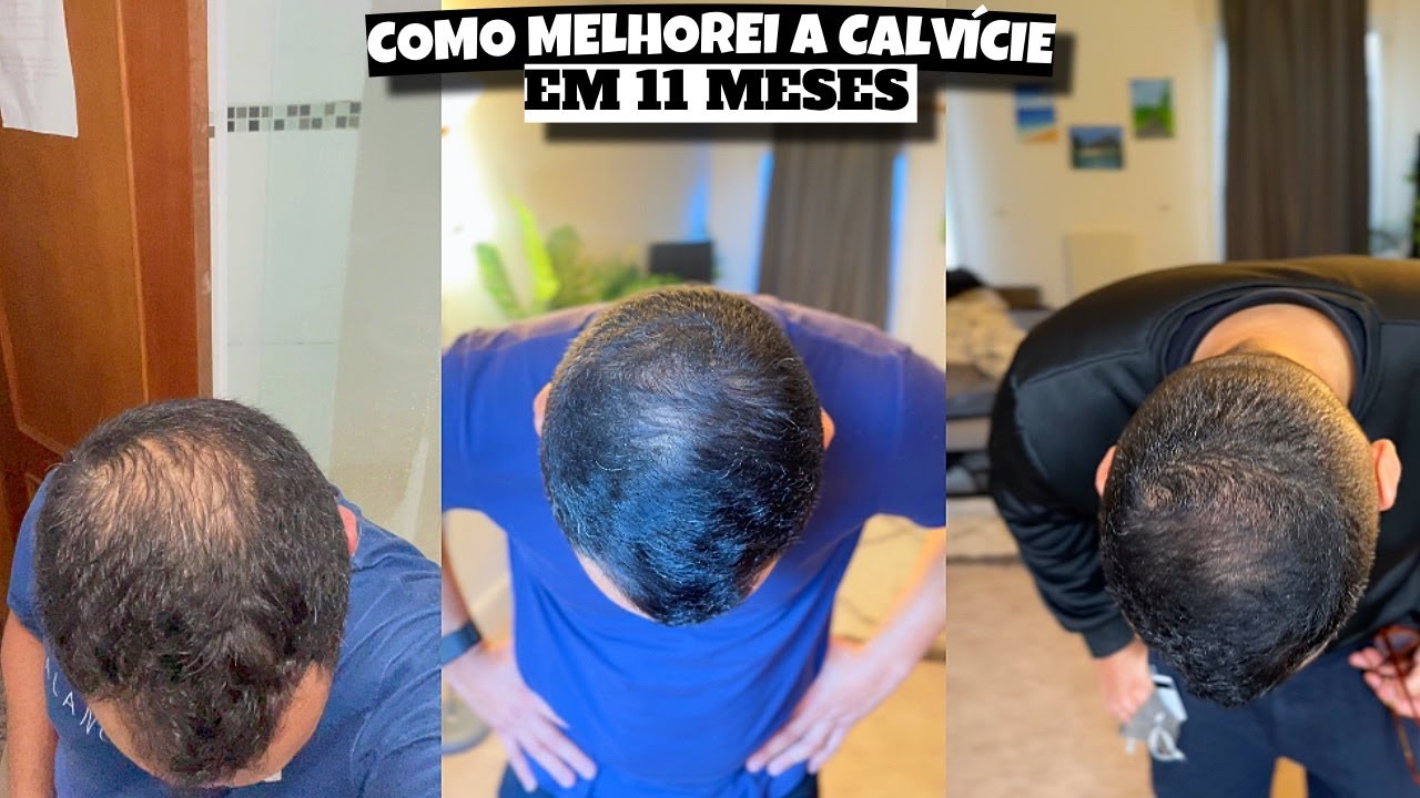 COMO ESTOU VENCENDO A CALVÍCIE ❤️ - Bruna Paula