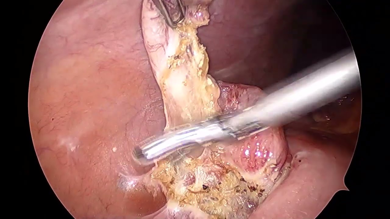 Laparoscopic Appendectomy without using endoloop
