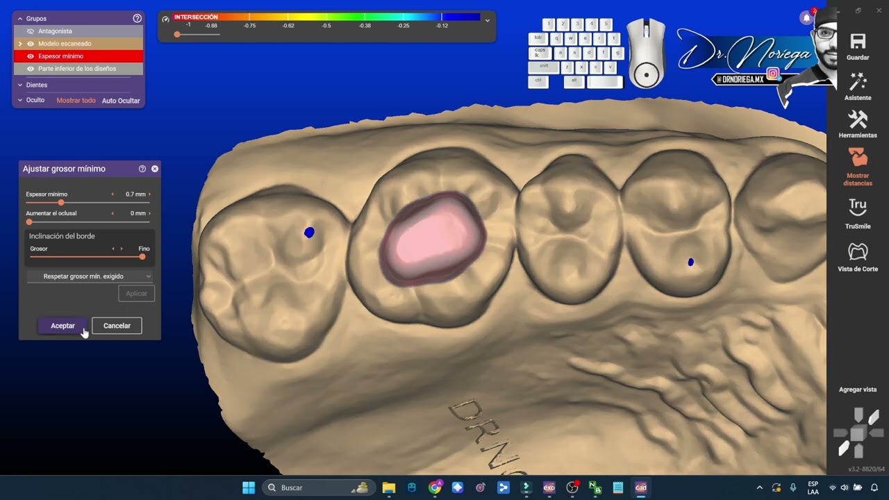 EXOCAD 3.2 ¬ INCRUSTACION INLAY [ Diseño Digital ] DR. NORIEGA