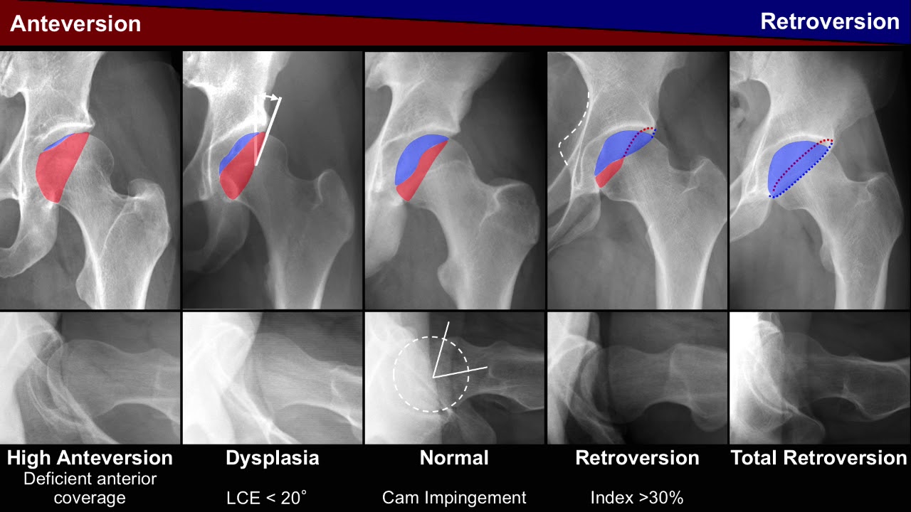 S. Steppacher, Pelvic incidence in acetabular retroversion, Hip Symposium 2018