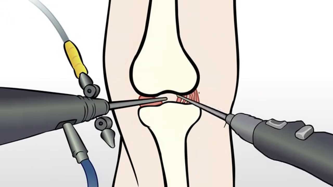 Regenexx Alternative to Knee Meniscus Surgery / Meniscectomy