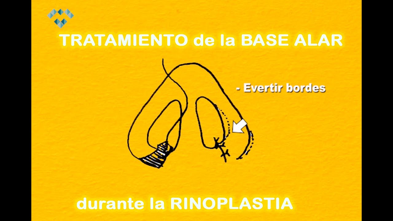 TRATAMIENTO de la BASE ALAR durante la RINOPLASTIA 👃😷