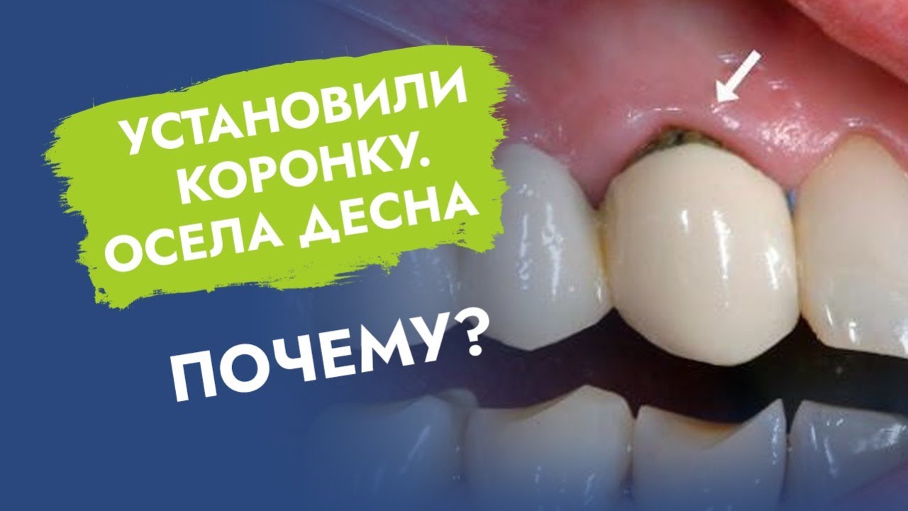 Поставили коронку. Осела десна.