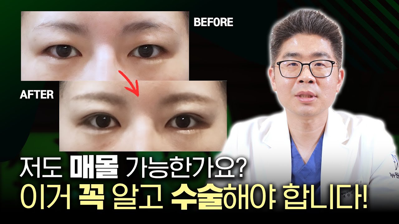 쌍꺼풀 수술 매몰법, 이거 꼭 알고 받아야합니다!