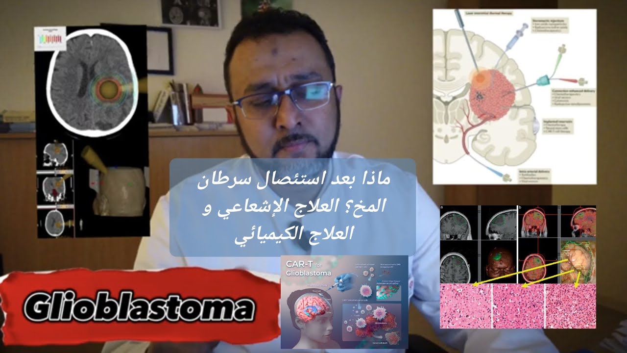 ماذا بعد استئصال سرطان المخ؟ العلاج الإشعاعي و العلاج الكيميائي، الضوابط و التوقيت #Glioblastoma