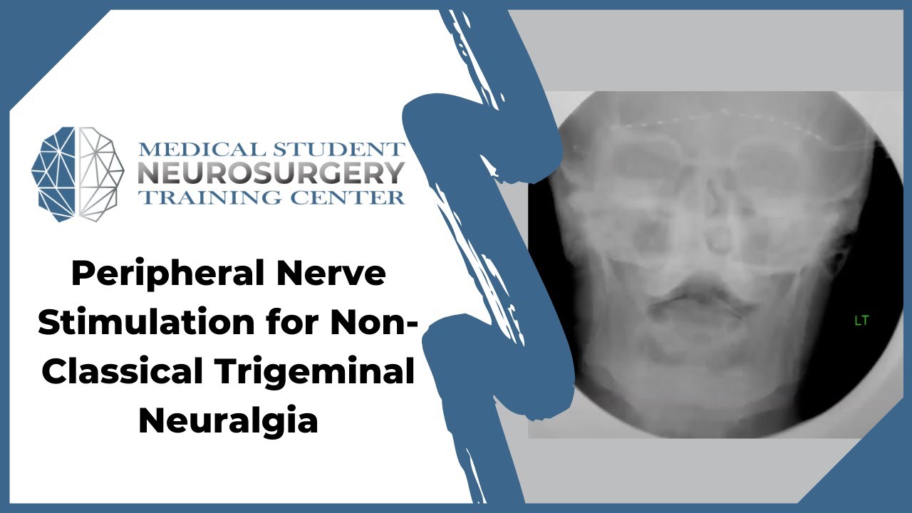 Peripheral Nerve Stimulation for Non-Classical Trigeminal Neuralgia