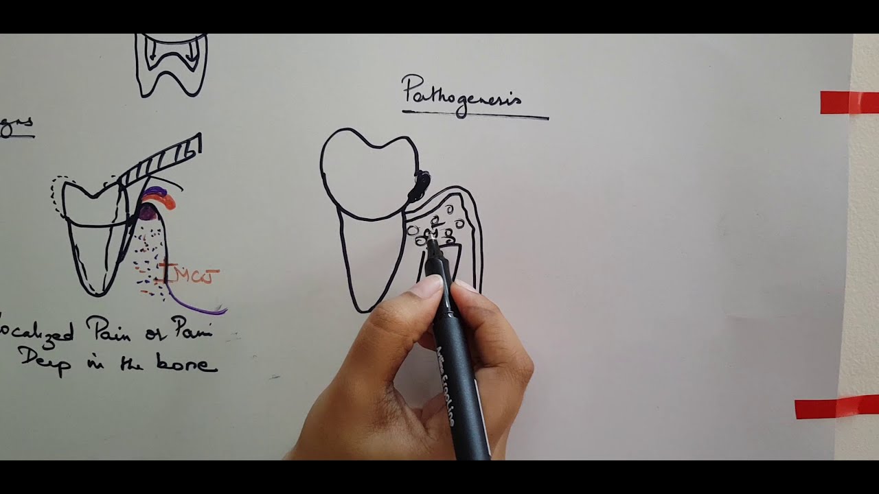 Periodontal Pocket  Part  1