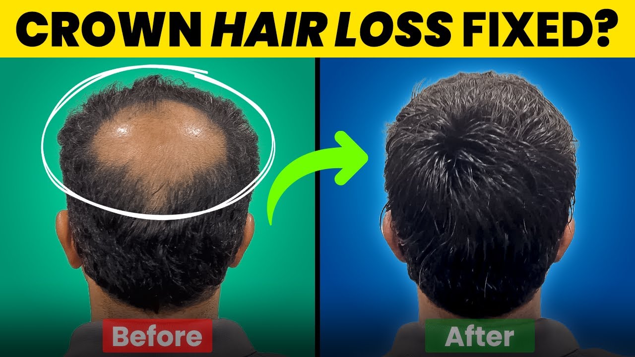 Fix Crown Area Hair Loss with a Customized Hair System