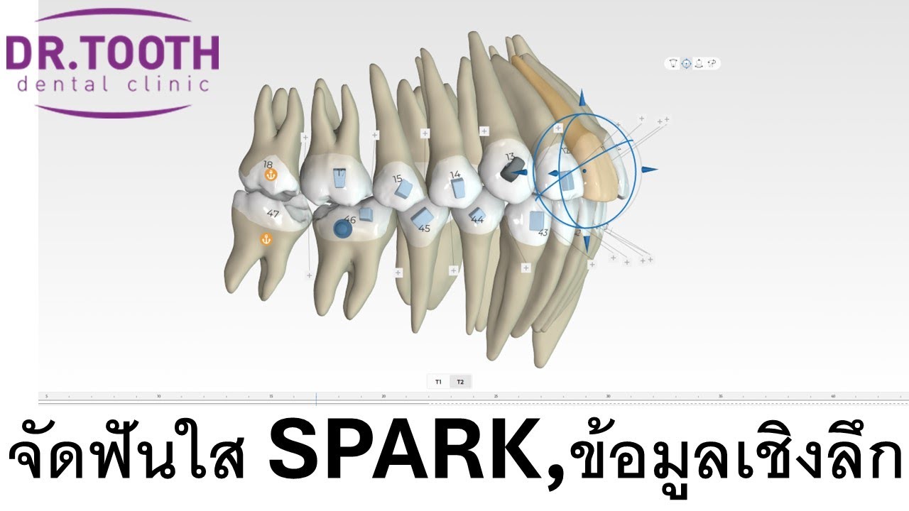 จัดฟันใส SPARK ระบบที่ดีที่สุดในปัจจุบัน ข้อมูลเชิงลึก #จัดฟันที่ไหนดี #จัดฟันใส 