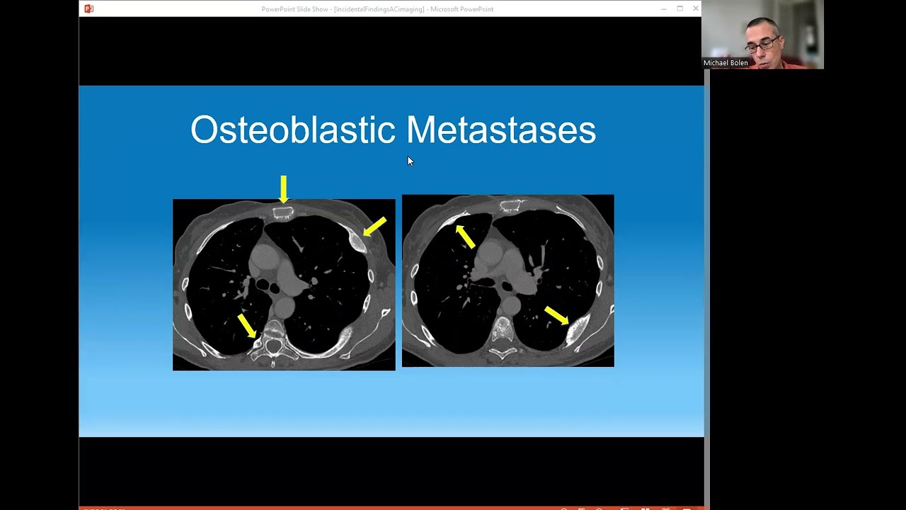 Incidental findings on AC imaging: a radiologist’s perpective