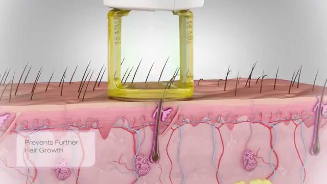 Gentle Hair Removal Video