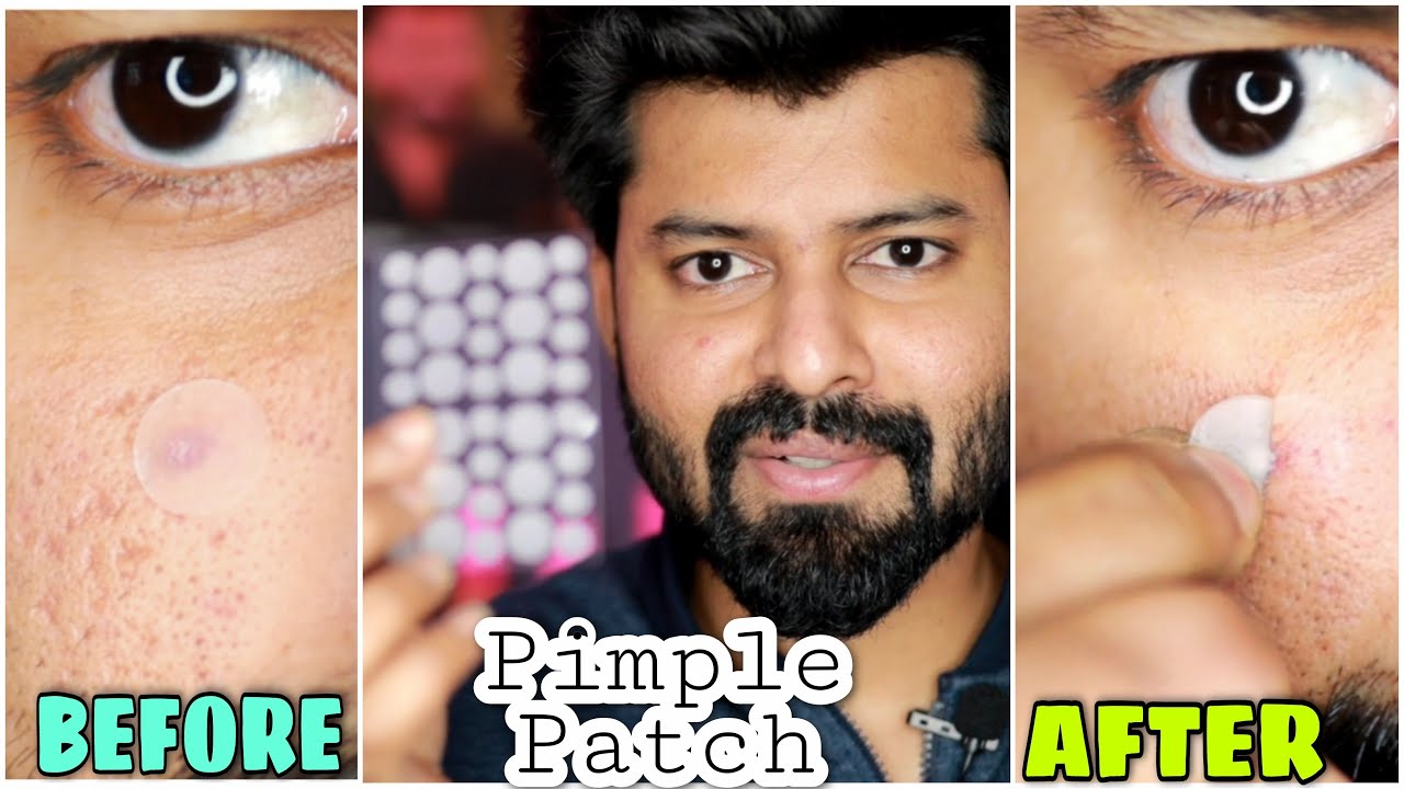 Pimple Patch Really Worked | One day Acne Control | Tamil | English subtitles | Shadhikazeez