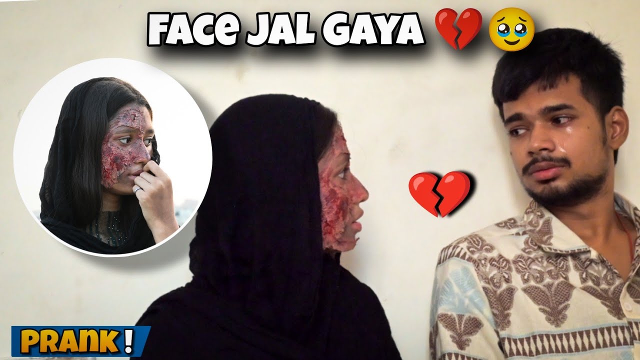 Burning Face Prank On Adi 💔 | Mr Adi