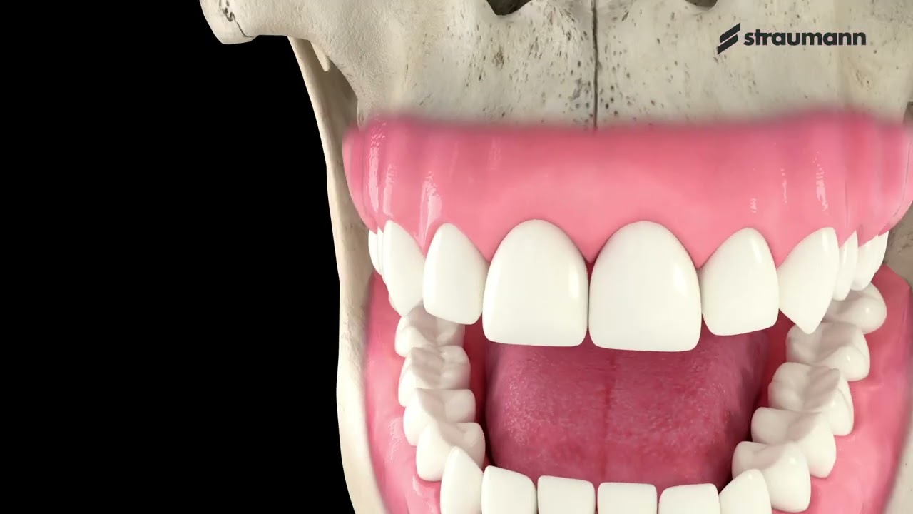 Angled Screw (AS) Custom Abutment