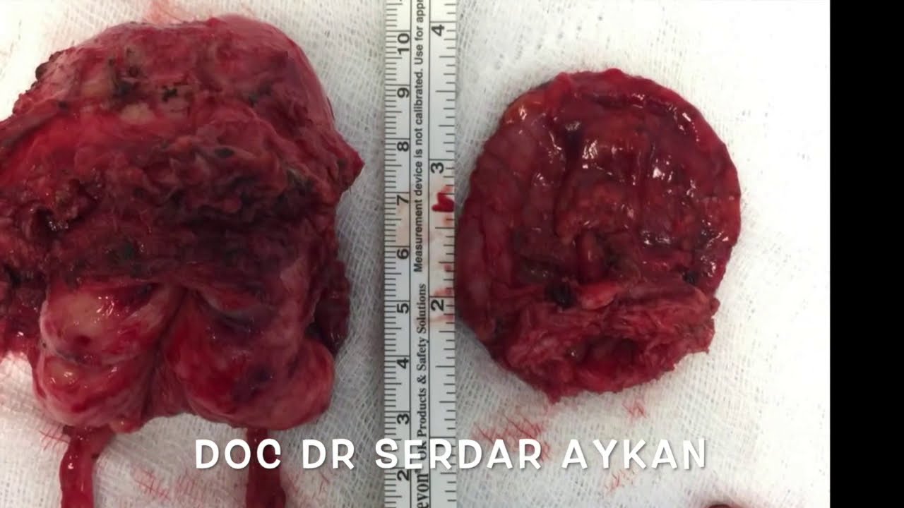 SA-47 LAPAROSCOPIC RADICAL PROSTATECTOMY - BLADDER DIVERTICULECTOMY. SERDAR AYKAN, MD Assoc Prof