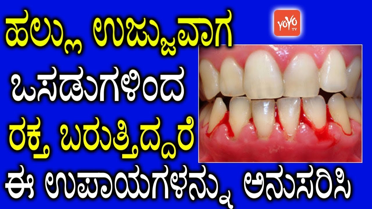 ಹಲ್ಲು ಉಜ್ಜುವಾಗ ಒಸಡುಗಳಿಂದ ರಕ್ತ ಬರುತ್ತಿದ್ದರೆ ಈ ಉಪಾಯಗಳನ್ನು ಅನುಸರಿಸಿ ! || YOYO TV Kannada Health